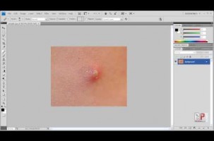 Photoshop CS4: Acne Removal